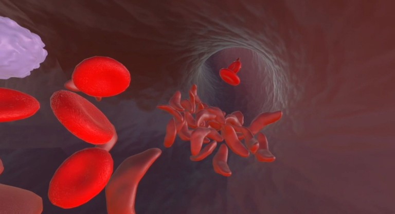 Illustration of sickle cells moving through a vein.