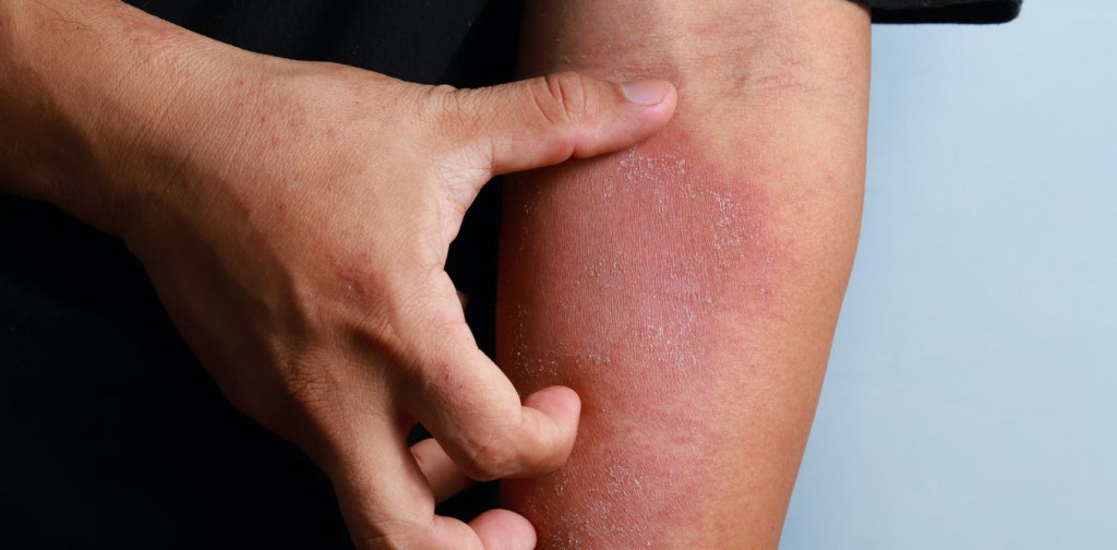 What is that rash? Genetic fingerprints can help doctors diagnose and treat skin conditions more effectively