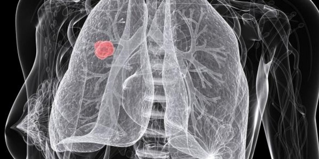 Cancer deaths are down an incredible 33% since 1991. Here’s why.