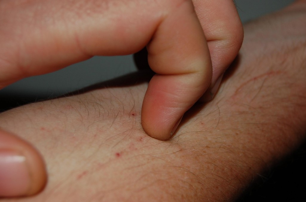 Common skin microbe causes itchiness, even without inflammation