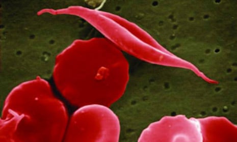US regulators approve two gene therapies for sickle cell disease
