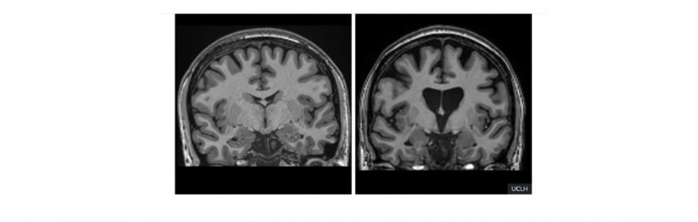 First Effective Huntington’s Treatment Is Gene Therapy Applied During Brain Surgery