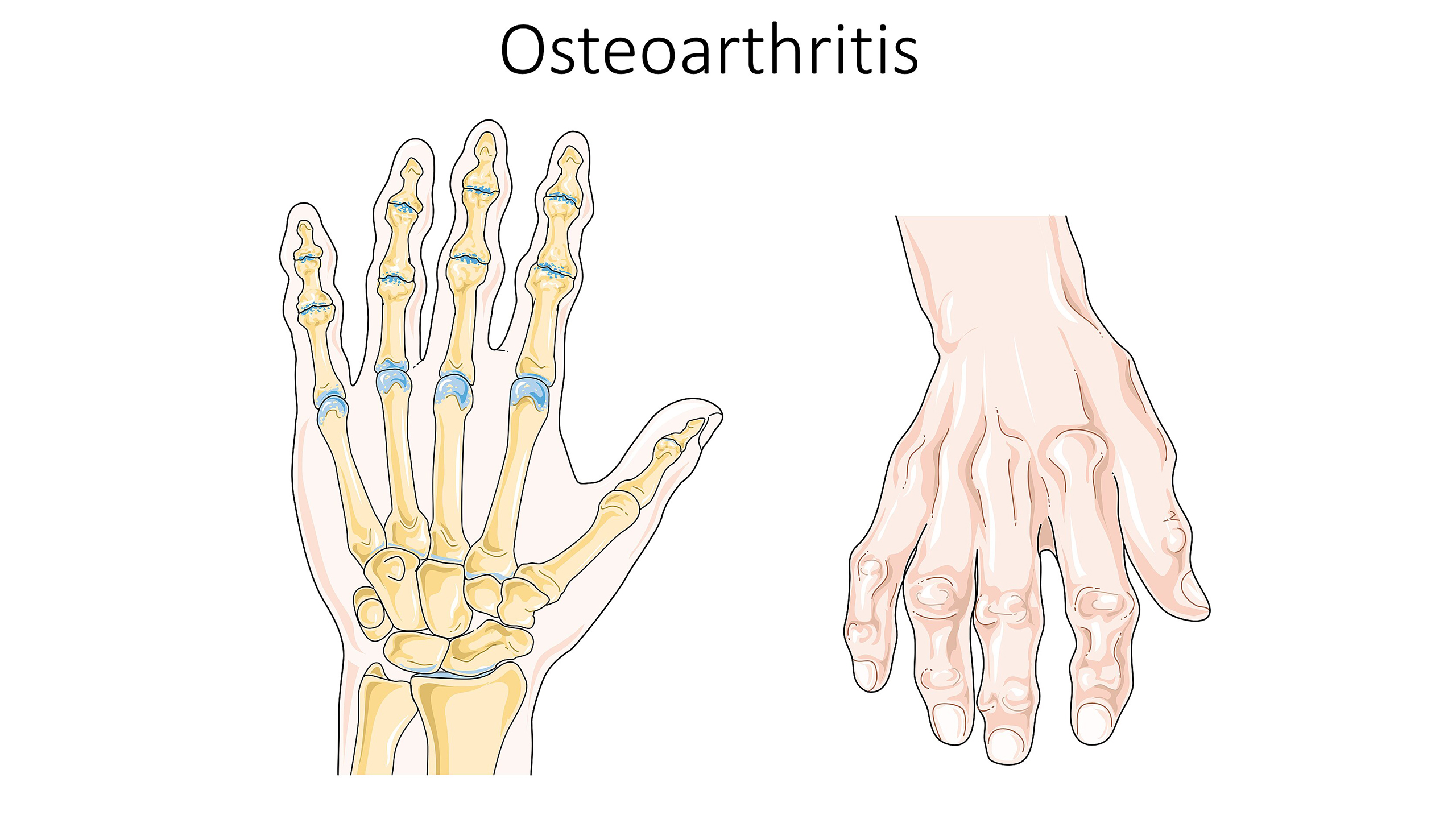 GLP-1 drugs shown to fight arthritis independent of weight loss