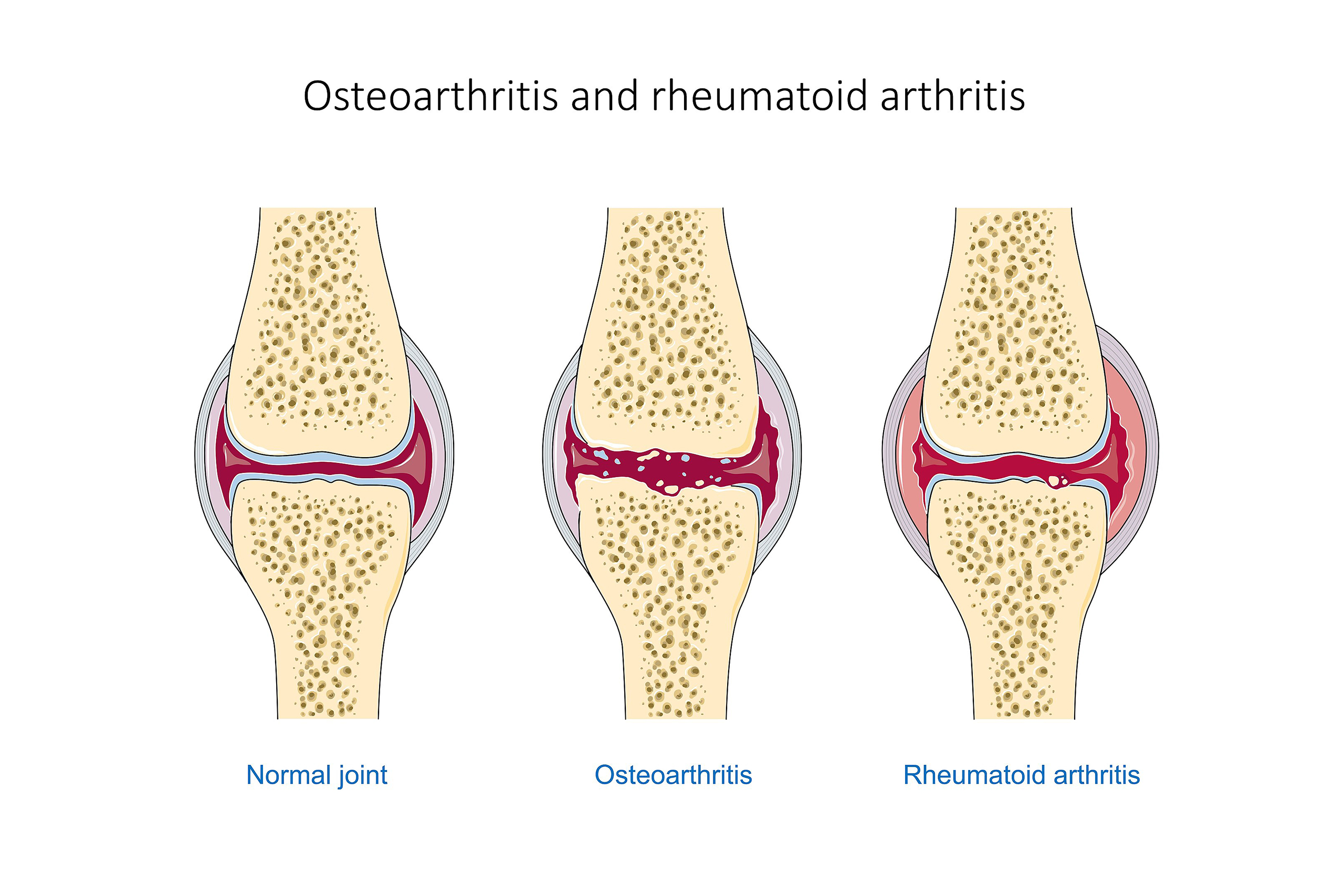 Experimental Drug Can Reverse Osteoarthritis in Weeks, Animal Research Shows