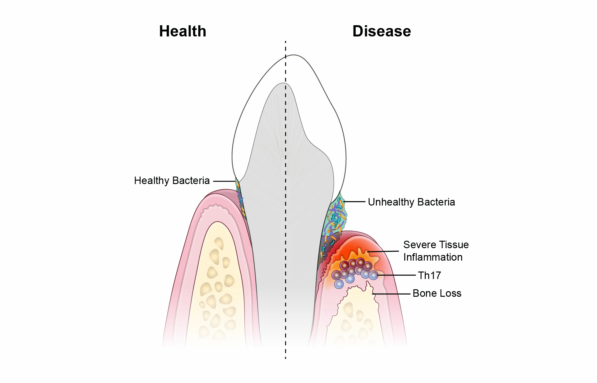 Common Supplements Show Antibiotic-Like Benefits Against Severe Gum Disease