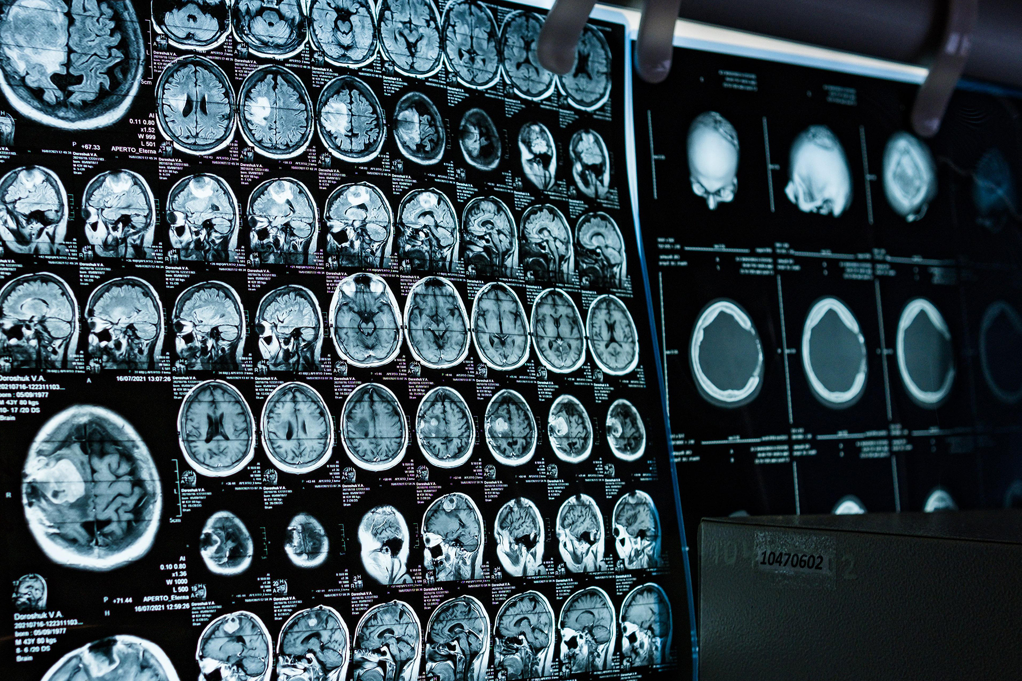 The Brain May Be Two Organs, a Discovery That Could Advance ALS Research